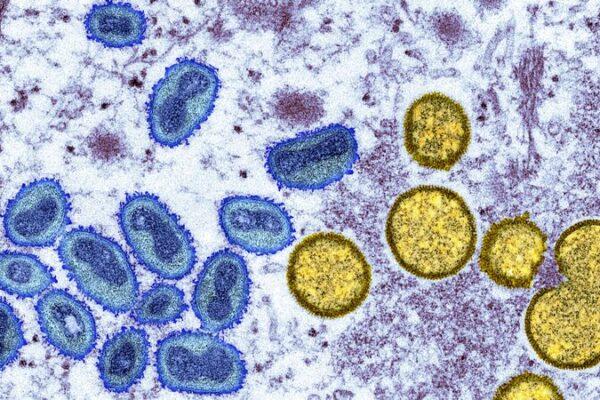 DRC declara ‘Emergencia Continental’ mientras el brote de Mpox cobra más de 570 vidas 💔 DRC_declara__Emergencia_Continental__mientras_el_brote_de_Mpox_cobra_ma_s_de_570_vidas__