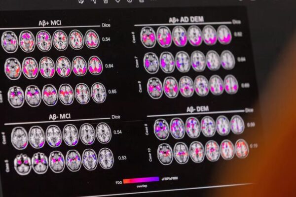 Estudio Encuentra que la Variante Doble del Gen APOE4 Casi Garantiza Alzheimer Estudio_Encuentra_que_la_Variante_Doble_del_Gen_APOE4_Casi_Garantiza_Alzheimer