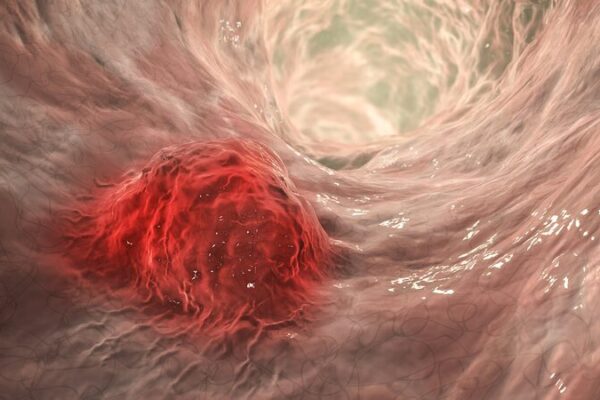 Investigadores_chinos_descubren_un_avance_probio_tico___para_combatir_el_ca_ncer_colorrectal