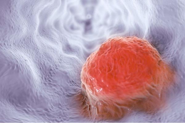 Una plataforma de IA duplica la detección temprana del cáncer de esófago Una_plataforma_de_IA_duplica_la_deteccio_n_temprana_del_ca_ncer_de_eso_fago