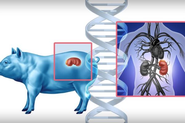 Trasplante de Riñón de Cerdo a Humano Desata un Avance Médico Trasplante_de_Rin_o_n_de_Cerdo_a_Humano_Desata_un_Avance_Me_dico