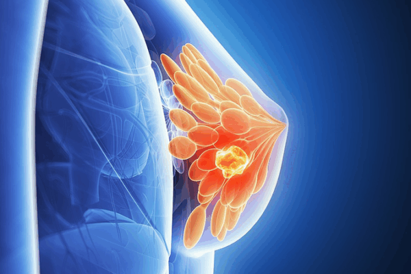 El sueño del cáncer revelado: Nuevas esperanzas para el tratamiento El sueño del cáncer revelado: Nuevas esperanzas para el tratamiento