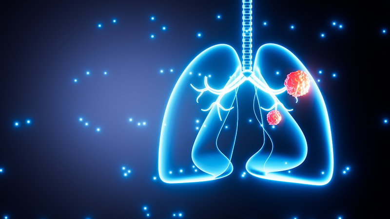 Estudio vincula la contaminación del aire con mutaciones de cáncer de pulmón en no fumadores