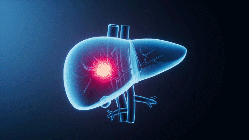 Informe liderado por China revela hoja de ruta global para vencer el cáncer de hígado