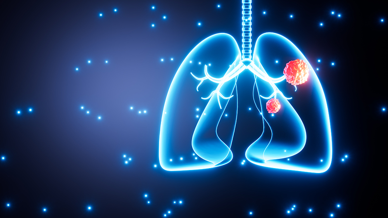 1 de cada 5 casos de cáncer de pulmón afecta a no fumadores